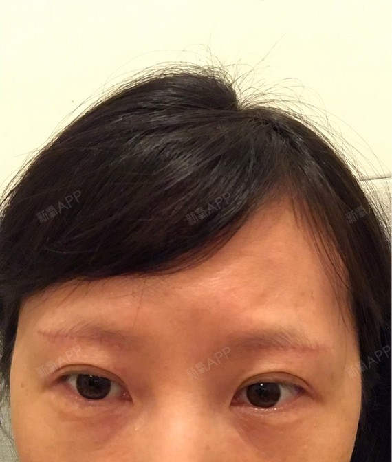27天了痕迹还是很明显,爱凤的自拍真的好奇怪,拍出来眼睛,脸都是歪的.