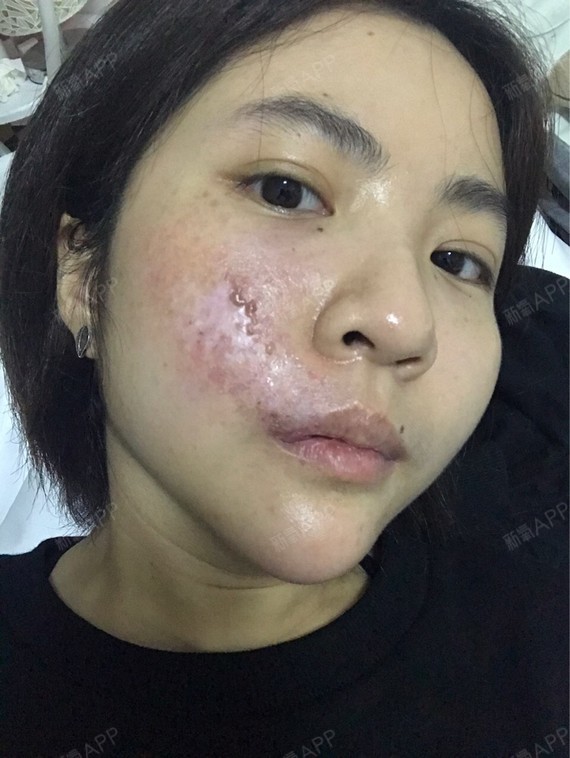 起了些水泡,但是是正常的,做激光那些,都会这样,希_圈子-新氧美容整形