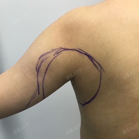 吸脂瘦手臂好不好_效果图_雪花酥吸脂瘦手臂术后第2天_新氧美容整形