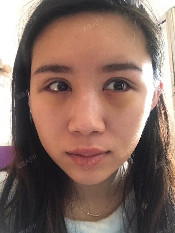 allison_下眼下至术第5天美丽日记-新氧美容整形