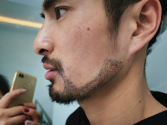 种植胡须好不好_效果图_氧气zxvfz种植胡须术后第0天_新氧美容整形