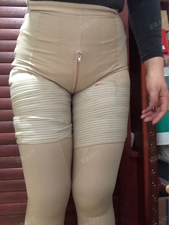 深圳吸脂瘦大腿好不好_效果图_小鸡腿子吸脂瘦大腿术后第16天_新氧