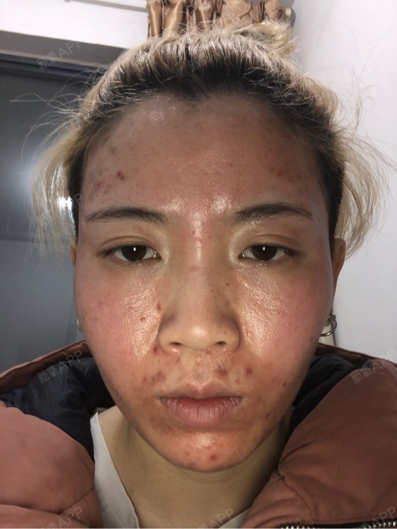 成都伊肤泉微针好不好_效果图_氧气z0xeo伊肤泉微针术后第0天_新氧