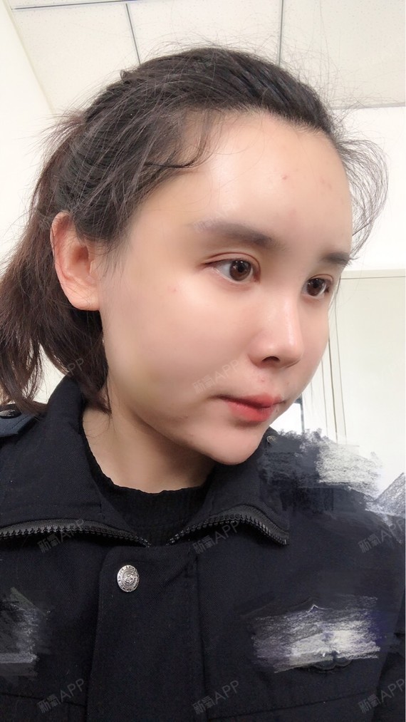 李五岁呀自体脂肪垫下巴第4天美丽日记