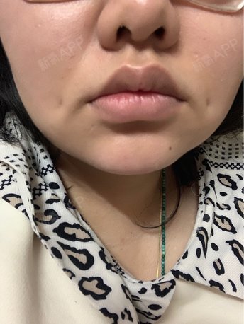 实话想这个梨涡,我是想了很多年了,在这之前很多人_圈子-新氧美容整形