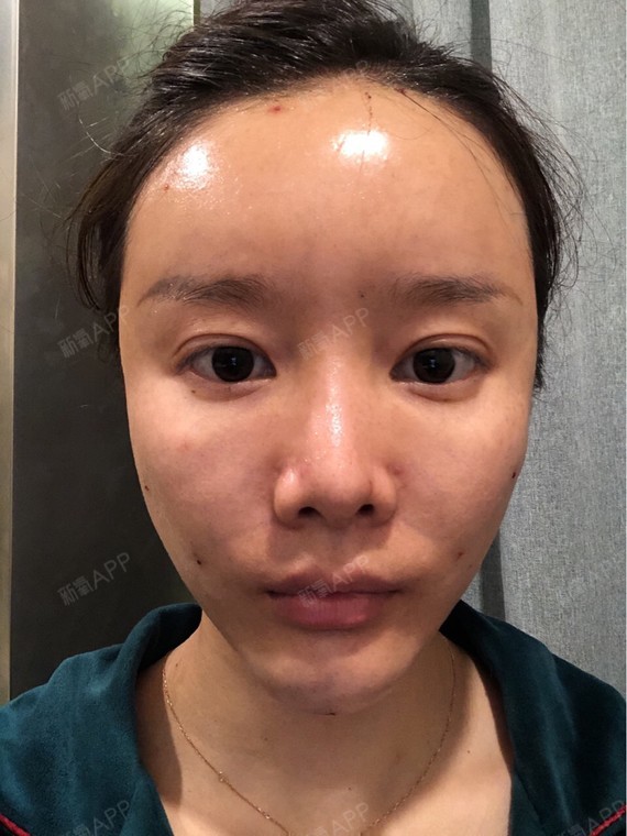 两点,才短短几个小时一觉醒来脸颊就凹进去一块了～这到底什么情况?