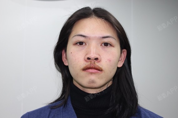因为一直以来唇外翻比较严重,化妆都无法遮掩,甚至是_圈子-新氧美容