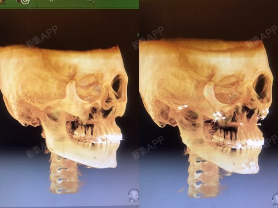 術前主要是顴骨顴弓問_圈子-新氧美容整形
