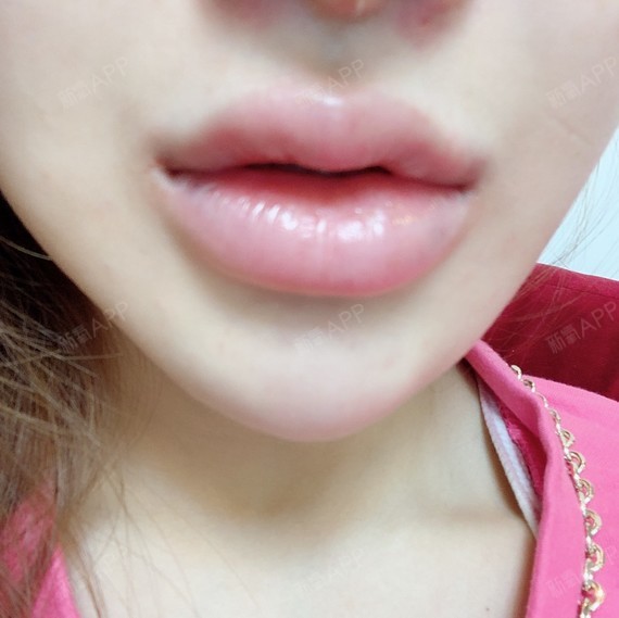 丰唇好不好_效果图_加油美少女玻尿酸丰唇术后第0天_新氧美容整形