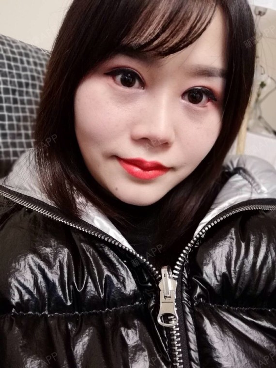 激光祛斑好不好_效果图_赞我激光祛斑术后第