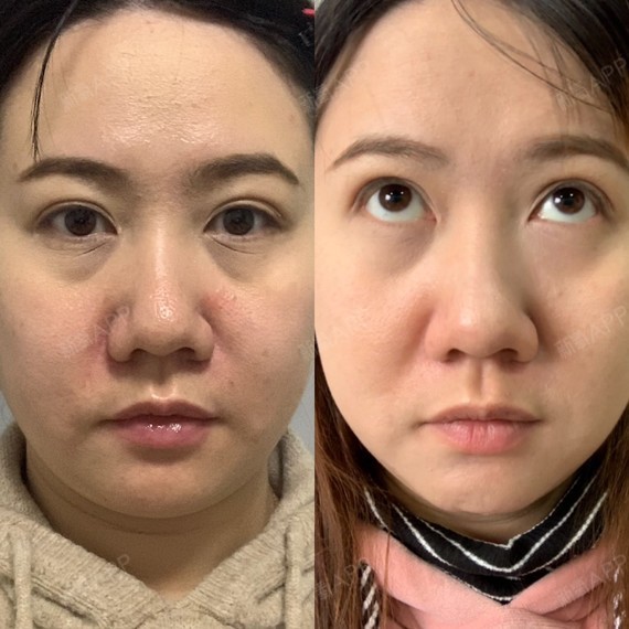 玻尿酸去法令纹好不好_效果图_氧气yph4c玻尿酸去法令纹术后第1天