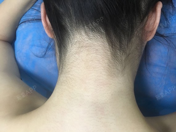 脱下我的"毛衣毛裤毛手套"医美冰点脱毛初体验!