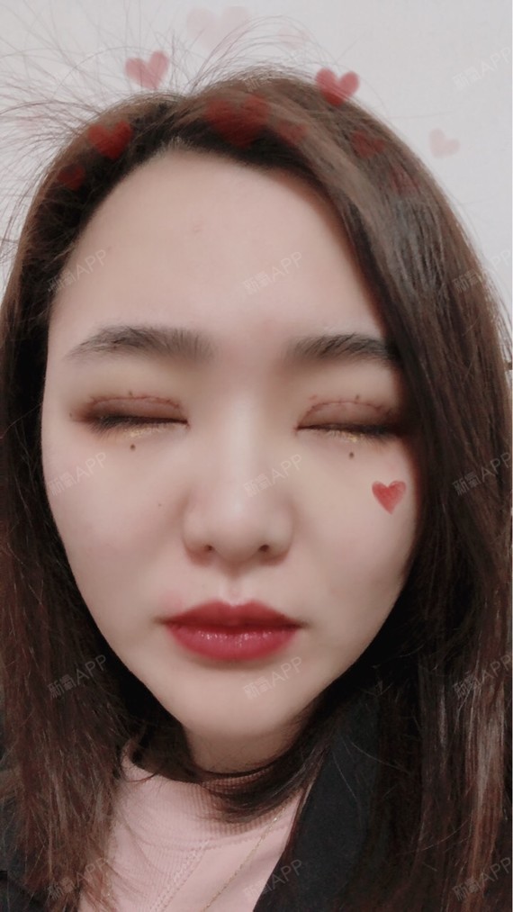 1zgnaw开内眼角第7天美丽日记