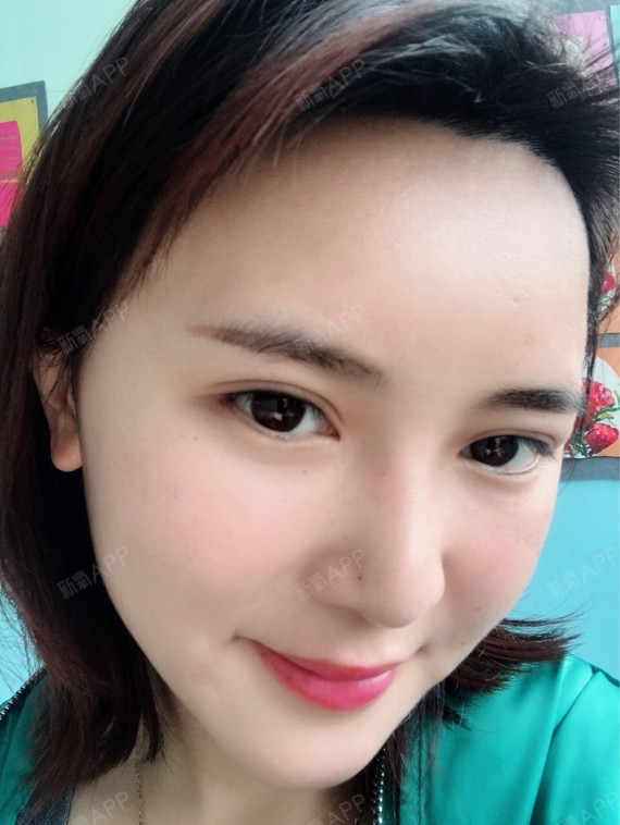 额头好不好_效果图_氧气yjh7d自体脂肪丰额头术后第24天_新氧美容整形