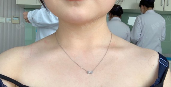 肉毒素瘦肩第一天.夏天快到了赶紧安排了.