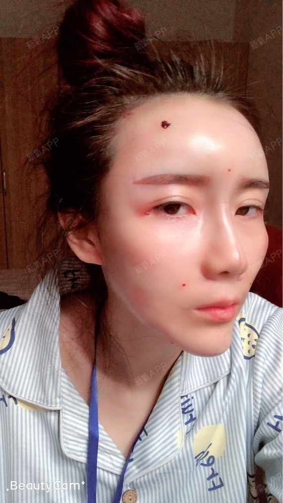 自体脂肪填充全脸