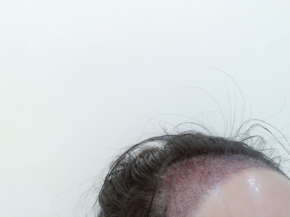 术后第二天额头太阳穴都开始水肿了