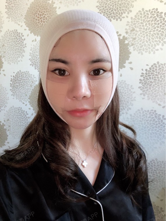 首尔面部吸脂好不好_效果图_幕尘面部吸脂术后第1天_新氧美容整形