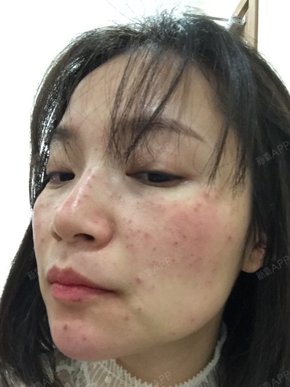 我要为舒医生打call，那天因为第一次做发现我竟然对麻药过敏，第一天没有