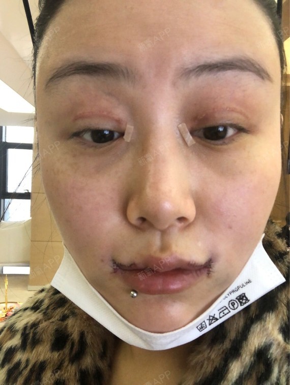 没有拆线的时候 人中特别肿              哦对了 我还做了嘴角上扬的