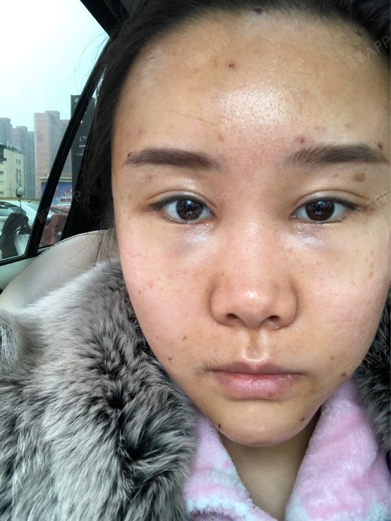 内切去眼袋好不好_效果图_氧气y8lfd内切去眼袋术后第3天_新氧美容