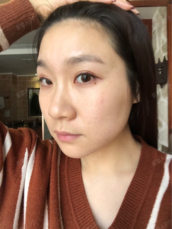最近我终于知道了,打了瘦脸针后,我脸颊凹陷的现象叫做"蛙腮"