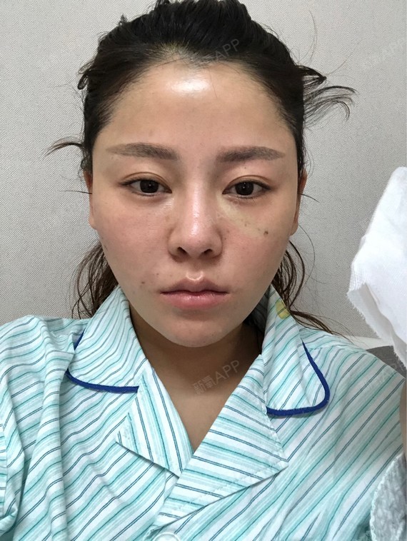 氧气jMRe926埋线提升第0天美丽日记-新氧美容