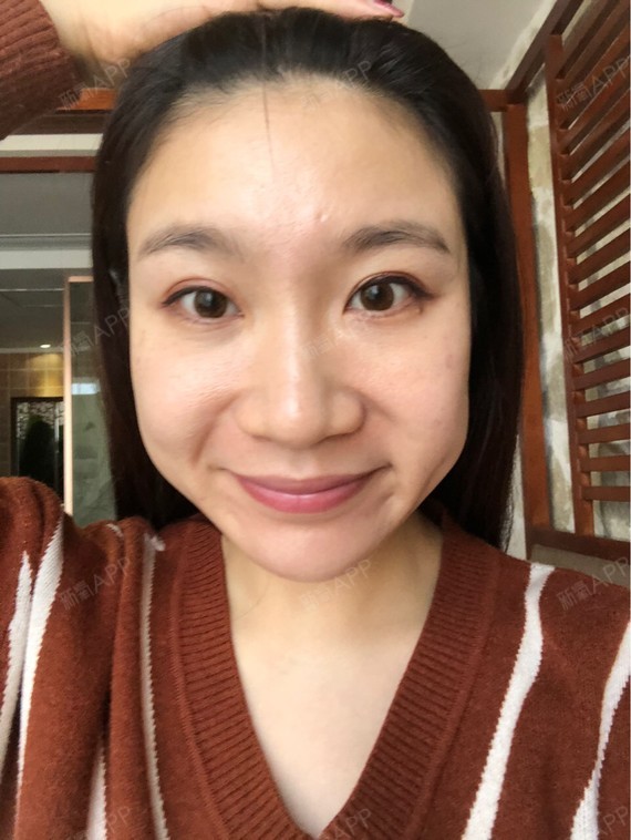 最近我终于知道了,打了瘦脸针后,我脸颊凹陷的现象叫做"蛙腮"