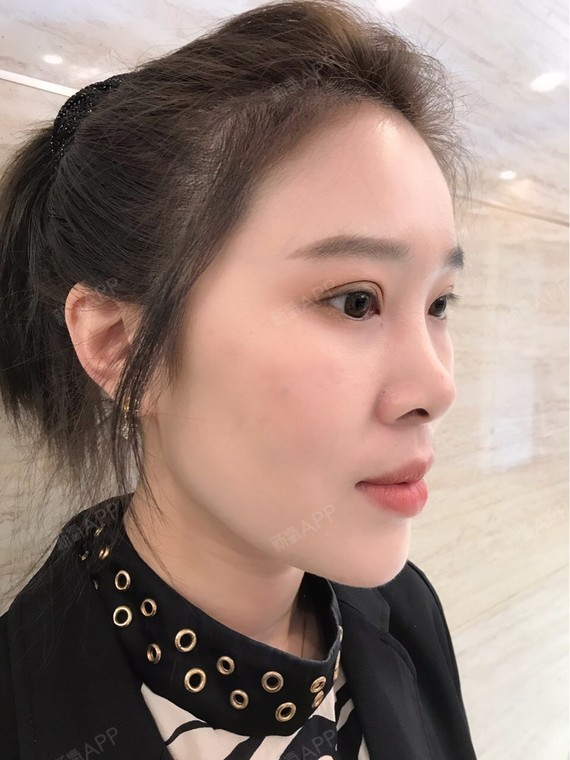 溶解酶好不好_效果图_氧气宝贝lisa溶解酶术后第0天_新氧美容整形
