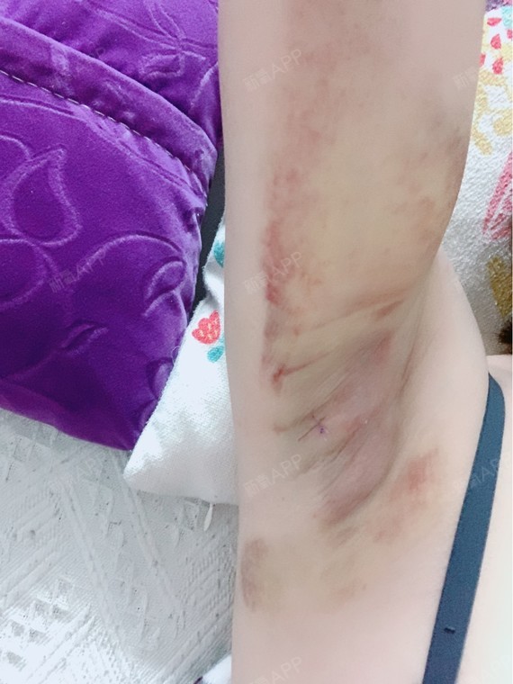 激光除腋臭好不好_效果图_氧气zq6h7激光除腋臭术后第3天_新氧美容