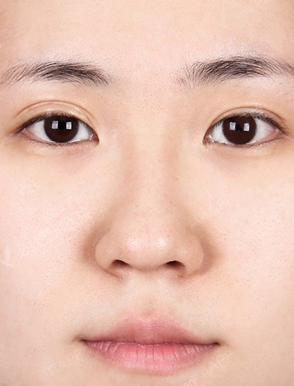 手术缩鼻头好不好_效果图_氧气zacqt手术缩鼻头术后第16天_新氧美容