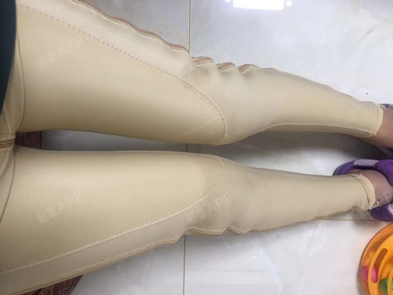 上海超声溶脂瘦大腿好不好_效果图_喵喵a43超声溶脂瘦大腿术后第14天