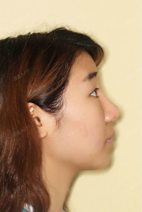 找到了两张术前术后照现在在医院没有人理我_圈子-新氧美容整形