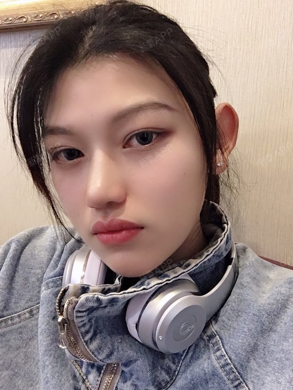 【武汉广爱医院手术缩鼻头77手术缩鼻翼第82天】前段_圈子-新氧美容