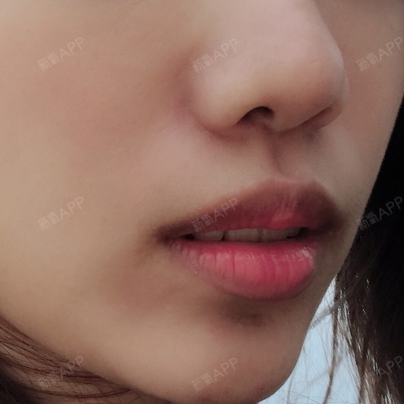 做出来的效果跟当初术前_圈子-新氧美容整形