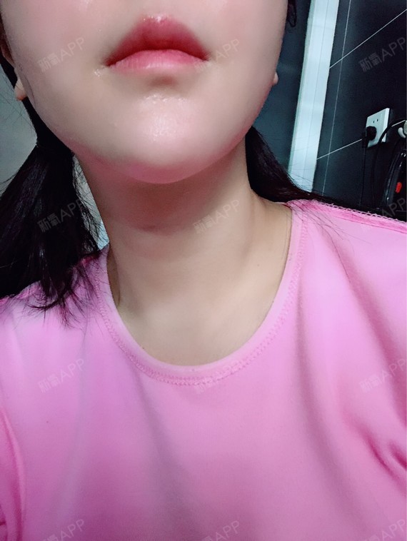 溶解酶溶唇部玻尿酸第7天,无论是从哪个角度看,嘴唇_圈子-新氧美容