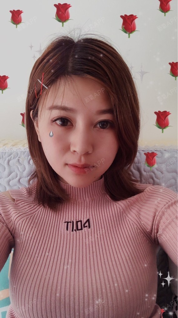 玻尿酸丰泪沟好不好_效果图_氧气qai2987玻尿酸丰泪沟术后第7天_新氧