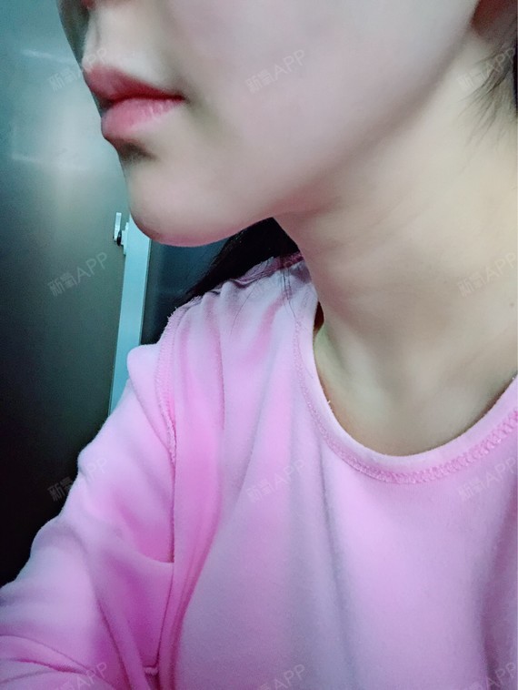 溶解酶溶唇部玻尿酸第7天,无论是从哪个角度看,嘴唇_圈子-新氧美容