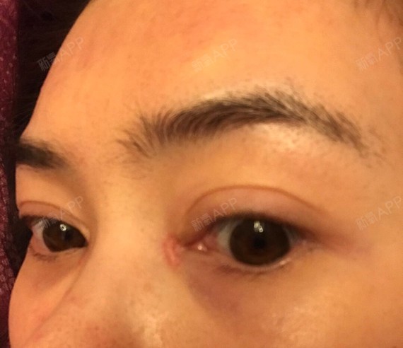 今天是术后两个月,现在这个白色疤痕凸起条状,有轻微_圈子-新氧美容