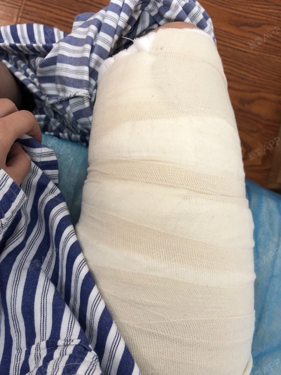 【武汉诠美@手臂吸脂】今天去医院拆线了,终于可以洗_圈子-新氧美容