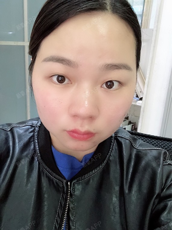 第七天了,第一次打瘦脸针.开始感觉咬肌有点无力,不过不影响吃东西.