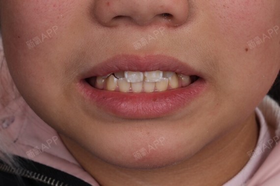 我的牙齿门牙前凸门牙旁边的牙齿凹进去,其他牙齿又不_圈子-新氧美容