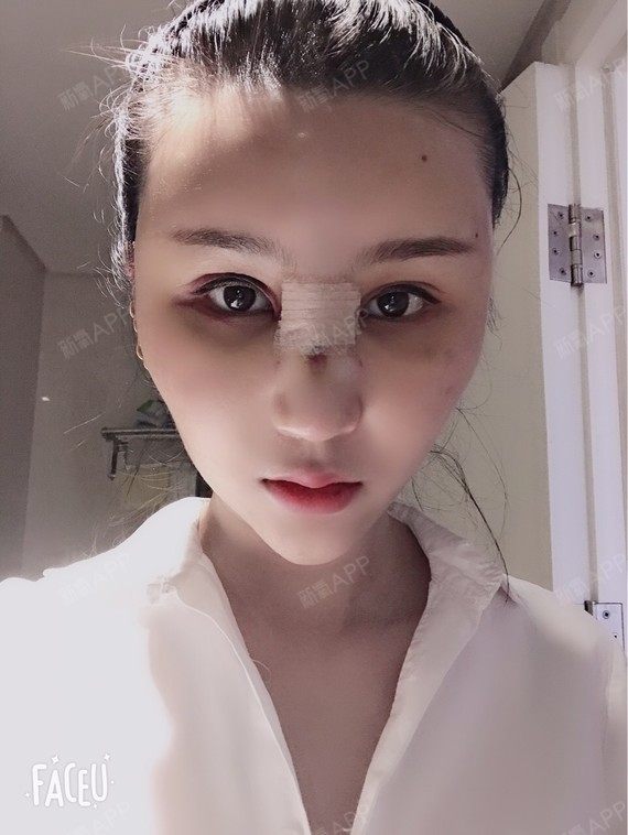 鼻子很肿,还有一大块淤血!