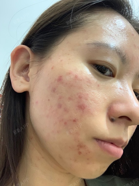 果酸换肤第四次的第二天脸干结痂了疼难看.