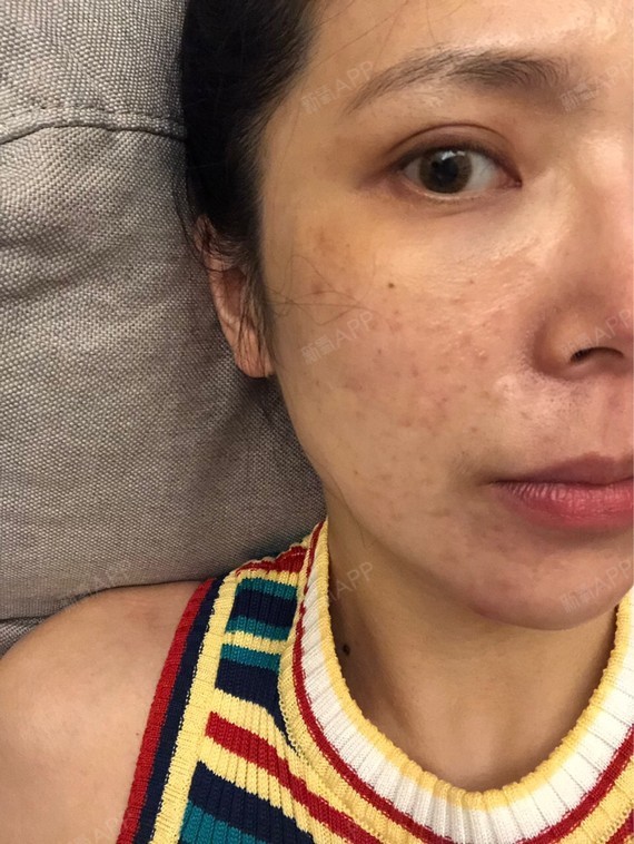 做完光子嫩肤第八天没化妆只涂了防晒iphone前置_圈子-新氧美容整形