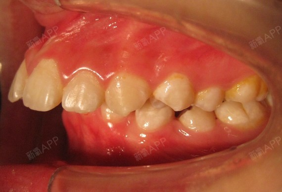 上下牙列轻度拥挤,上切牙唇倾,下切牙直立.