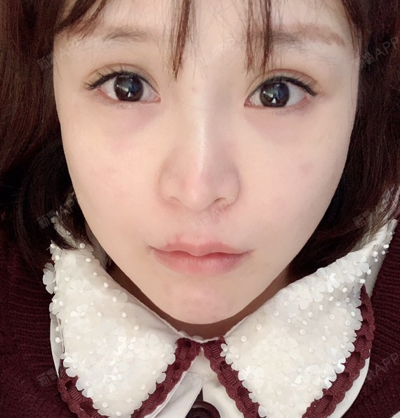 成都嘴角上扬术好不好_效果图_我要变成瘦瘦的美女嘴角上扬术术后第76