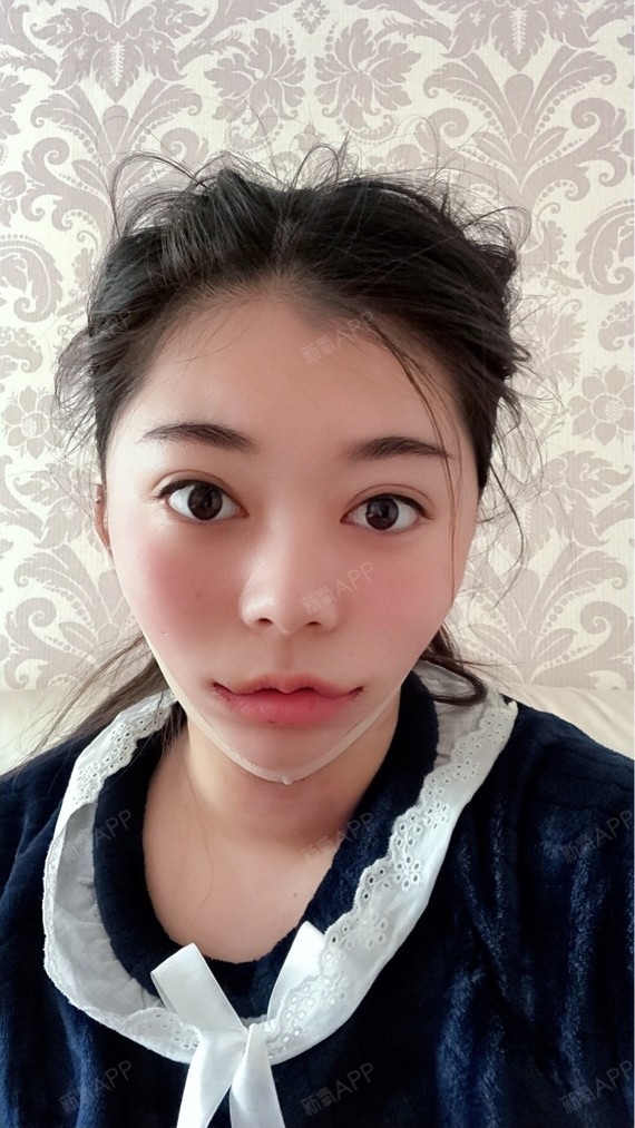 成都面部吸脂好不好_效果图_是琦琦呀面部吸脂术后第2天_新氧美容整形