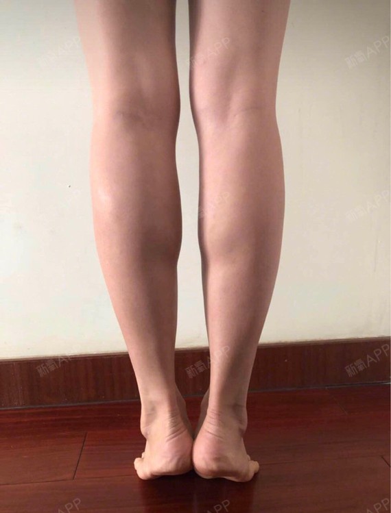 【武汉诠美@瘦腿针】腿部有一点点淤青,但是感觉外侧_圈子-新氧美容
