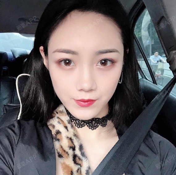 自体脂肪填充全脸